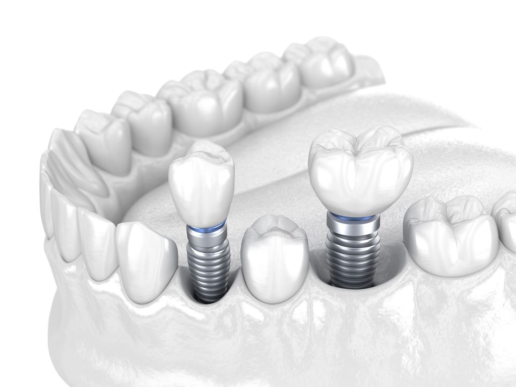 dental implants near you