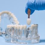 Dental Implants Explained: The Modern Way to Replace Missing Teeth
