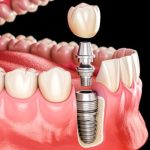 Is Getting a Single-Tooth Implant Painful? What to Expect During the Procedure